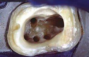 Microscopic Dental Fillings